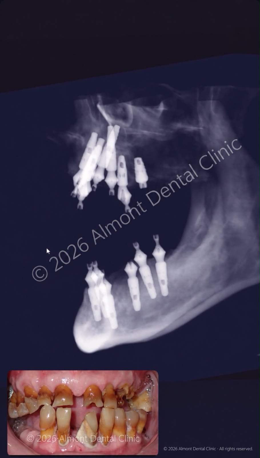 Dental X-ray showing extensive tooth loss and existing implants